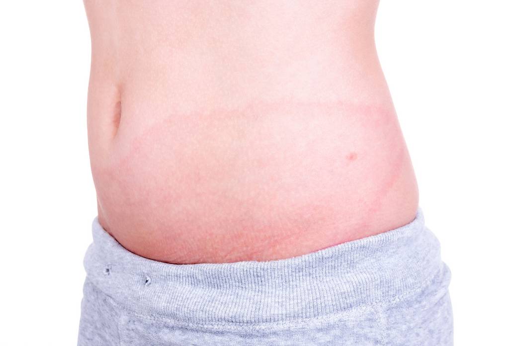 Dealing With Lyme Disease And Mold Illness 5 Mold Illness Results In Skin Sensitivity