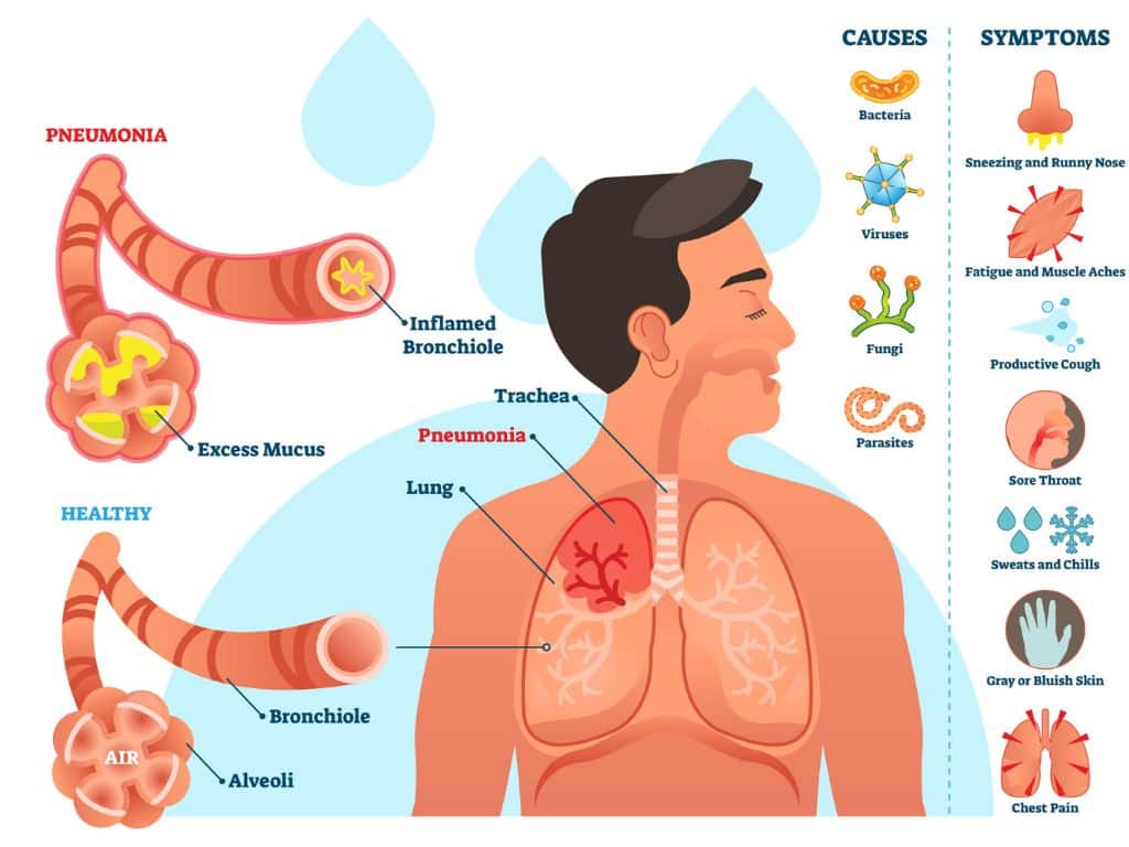 Mycotoxins And Mold: How Does It Affect You And Your Family? 8 Pneumonia Caused By Mycotoxins