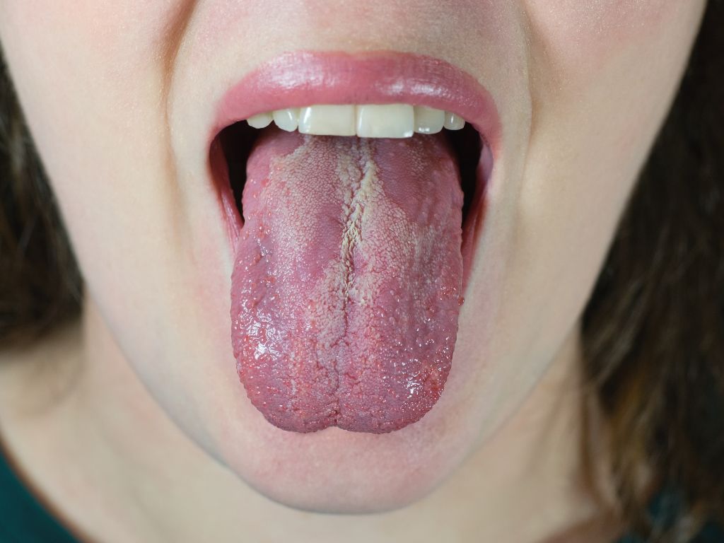 Disseminated Fungal Infections: Unveiling The Silent Threat 3 Oral Thrush