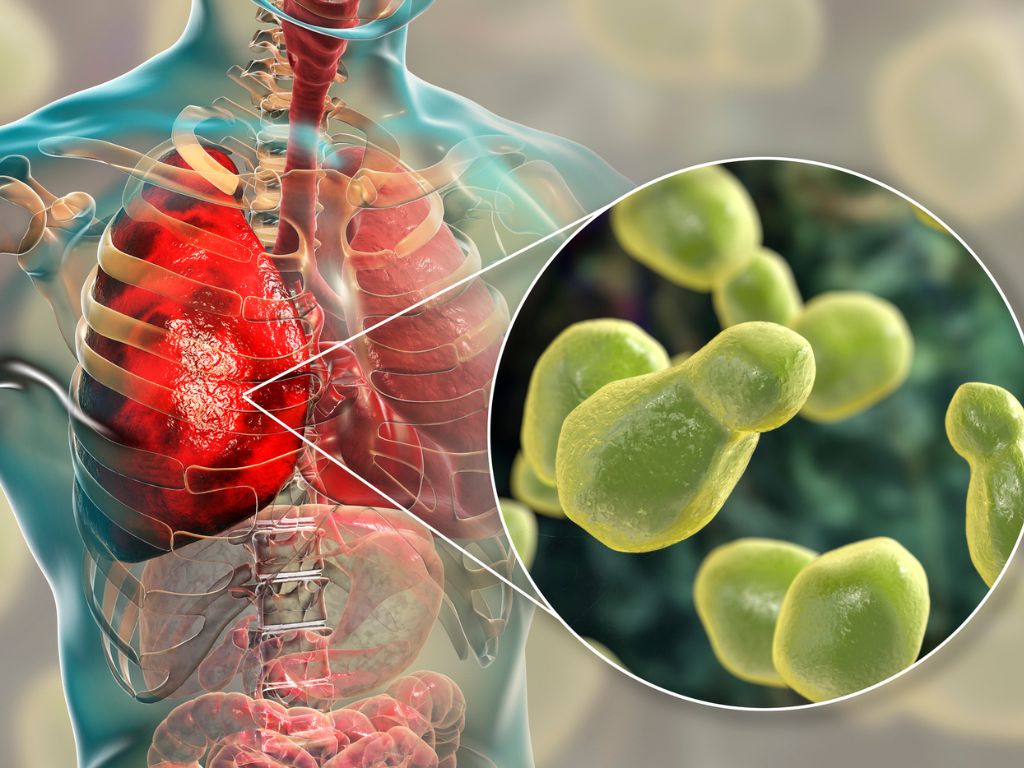 Disseminated Fungal Infections: Unveiling The Silent Threat 4 Pulmonary Cryptococcosis